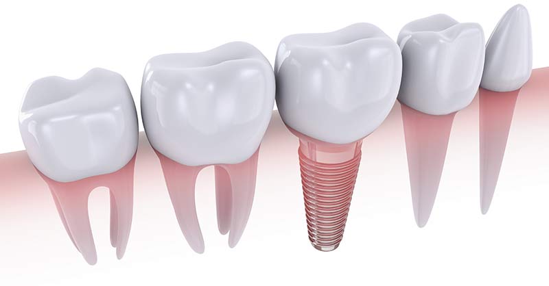A dental implant is an artificial tooth root, typically a titanium screw, that is placed into your jaw bone to hold a replacement tooth or a bridge or denture to restore multiple missing teeth. Contact Naperville Dental Specialists to help you decide if Dental Implants are right for you.